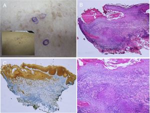 Carcinoma de células escamosas desarrollado sobre nevus epidérmico, previamente tratado con electrocoagulación. A) Foto clínica panorámica y detalle. B) HE, 4x: dos de las tres lesiones que se biopsiaron mostraban una proliferación epidérmica y formación de cordones que invadían la dermis reticular. C) Inmunohistoquímica con citoqueratina AE1/AE3, 4x: estos cordones de células epiteliales invadían la dermis. D) GE, 10x detalle de la proliferación neoplásica compuesta por queratinocitos atípicos que forman queratina y perlas córneas. Imágenes clínicas cedidas por la Dra M. Concepción Sánchez Bermejo y la Dra María José González, del Hospital de Manacor.