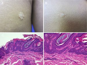 Dos nevus PENS en el mismo paciente. A y B) Dos placas de 8mm y 5mm respectivamente, de forma redondeada en el primer caso y poligonal, algo lineal en el segundo. C) HE, 4x: la biopsia mostraba una hiperplasia epidérmica con cretas engrosadas y fusionadas, con papilomatosis e hiperqueratosis compacta. D) HE, 10x: a mayor detalle se observa cómo la capa basal de células en la epidermis tiene un aspecto en empalizada.