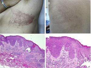 Enfermedad de Darier segmentaria. A y B) Imágenes clínicas de la lesión submamaria y dorsal izquierdas en una paciente sin más lesiones cutáneas. C) HE, 4x: la biopsia mostraba una acantosis epidérmica con mínima hiperqueratosis ortoqueratósica, acantólisis suprabasal y formación de una ampolla intraepidérmica. D) HE 10x: a mayor aumento se apreciaban mejor los cambios disqueratósicos con la presencia de cuerpos redondos y granos. La paciente fue diagnosticada de enfermedad de Darier segmentaria.