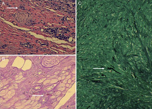 A) Tinción hematoxilina-eosina ×200: se aprecian granulomas y células gigantes multinucleadas. La flecha blanca señala una de las células gigantes multinucleadas. B) Tinción de PAS ×400 en donde se ponen en evidencia hifas de aspecto tortuoso. La flecha blanca señala una de las hifas. C) Tinción de plata ×200, en donde se ponen en evidencia hifas de aspecto tortuoso. La flecha blanca señala una de las hifas.