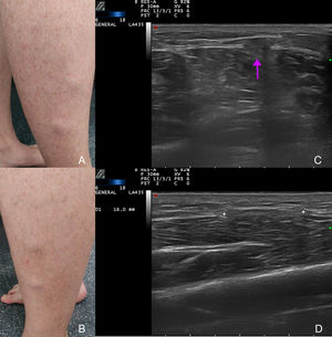 A) Nódulos en cara lateral de la pierna derecha. B) Nódulos en cara lateral de la pierna izquierda. C) Ecografía modo B: protrusión del músculo durante la contracción a través del defecto de la fascia (flecha). D) Ecografía modo B: discontinuidad de la fascia durante la relajación muscular (entre marcadores).