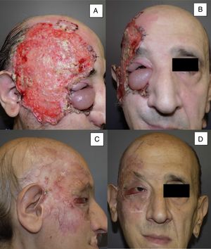 Varón de 53 años con CBC infiltrante ulcerado de 14×10cm localizado en región temporal derecha y órbita derecha con edema palpebral asociado e infiltración de adenopatías (A y B). Tras 8 meses de tratamiento, a nivel clínico parece observarse una respuesta completa al tratamiento (C y D). No obstante, en una biopsia de control realizada durante el seguimiento del paciente, se siguen observando restos tumorales, clasificándose como respuesta parcial (caso 11 en la tabla 1).