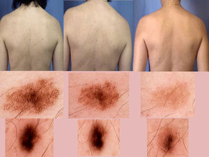 Imágenes clínicas y dermatoscópicas que muestran los cambios en los nevus.