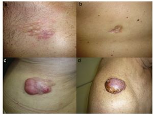 a: Dermatofibrosarcoma protuberans en placa localizado en la región clavicular tipo placa morfeiforme; b: dermatofibrosacoma protuberans en placa en la espalda tipo placa atrófica; c: dermatofibrosarcoma protuberans multinodular en la zona lumbar; d: Dermatofibrosarcoma protuberans tipo nodular en el hombro.