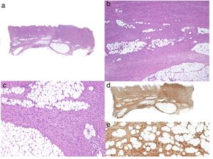 Histología típica de un dermatofibrosarcoma protuberans.a: Panorámica con hematoxilina eosina; b y c: infiltración dérmica e hipodérmica por el tumor; d: panorámica de la tinción intensamante positiva con CD34; e: detalle de las células fusiformes entre los adipocitos que muestran tinción intensa de CD34.