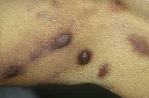 Sarcoma de Kaposi clásico localizada en piernas. Nódulos y placas eritematomarrónaceas en la extremidad inferior.