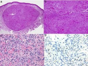 Histología del sarcoma de Kaposi. a) Visión panorámica de sarcoma de Kaposi en fase nodular. Nódulo bien circunscrito en dermis. b) Lesión densamente celular con algún espacio en forma de grieta. c) Detalle de las células fusiformes y de los hematíes en el interior de los pequeños vasos. d) Positividad nuclear para la inmunohistoquímica VHH-8 específica del sarcoma de Kaposi.