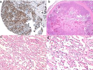 a) La inmunohistoquímica corresponde a un angiosarcoma cutáneo que muestra positividad para ERG (típicamente de patrón nuclear). b) Angiosarcoma con predominio de áreas con patrón vasoformativo. c,d) En las fotos de detalle se muestran los endotelios neoplásicos, que en este caso resultan prominentes pero sin atipia llamativa.