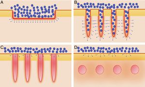 Distintos tipos de láseres empleados en la vehiculización de fármacos asistida por láser. A) Láseres totalmente ablativos: CO2 (10.600nm) y Er:YAG (2.940nm) principalmente; realizan una ablación total, no fraccionada, de la epidermis, permitiendo a las moléculas alcanzar la dermis. B) Láseres fraccionales ablativos: los mismos tipos que en A, en su versión fraccionada; generan canales de microablación que utilizan los fármacos para penetrar hasta la dermis. C) Láseres fraccionales no ablativos: por ejemplo, Er:Glass 1.550nm, entre otros; generan columnas de microcoagulación sin llegar a producir ablación de la epidermis. D) Remodelación dérmica no ablativa: se agrupan en este subtipo todos aquellos láseres con cromóforos distintos al agua, que producen un depósito de energía en la zona en la que se encuentre su cromóforo, generalmente en la dermis, como por ejemplo los láseres vasculares como el colorante pulsado 585/595nm o el Nd:YAG 1.064nm.