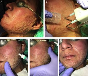 Ejemplo de la vehiculización de acetónido de triamcinolona asistida por un láser fraccional ablativo de CO2 en una paciente con una secuela de una quemadura facial. A) Antes de la realización del tratamiento. B) Pase de láser CO2 con un escáner fraccional sobre toda la superficie de la quemadura facial; se emplea un extractor de humos asociado al tratamiento. C) Aplicación del acetónido de triamcinolona al 10% en solución inyectable: se aplica tópicamente sobre la zona tratada con láser. D) Extensión del corticoide por toda la superficie de la quemadura. E) Masaje suave para conseguir una mejor penetración del producto.