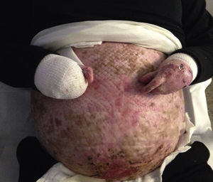Paciente 1. Erosiones en abdomen tras la realización de cesárea y seudosindactilia en ambas manos.