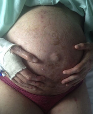 Paciente 2. Abdomen previo a una cesárea y anoniquia parcial.