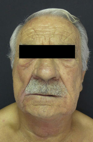 Cuello, región malar izquierda y derecha, surcos nasogenianos y reborde infraorbitario derecho edematosos con un tinte violáceo.