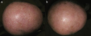 a) Múltiples pápulas milimétricas, monomorfas y blanquecinas en región parietooccipital. b) Evidente mejoría de los quistes de milio en región parietooccipital con queratolíticos suaves.