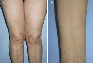 Aspecto clínico de las lesiones de mastocitosis máculo-papulosa en los muslos (a) y en el antebrazo (b).