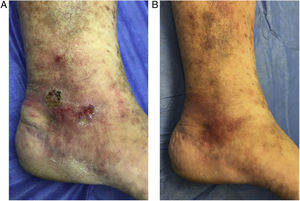 A) Úlcera venosa pretratamiento. B) Resolución completa a las 4 semanas con mejoría de la piel circundante.