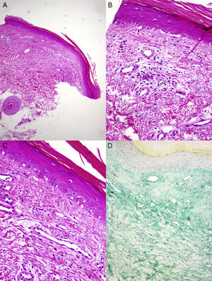 A y B) El examen histopatológico muestra paraqueratosis, discreta atrofia epidérmica, exocitosis linfocitaria y focos de vacuolización de la capa basal, con ocasionales queratinocitos apoptóticos (hematoxilina-eosina, ×4, ×10). C) En la dermis se observan proliferación vascular y ligera fibrosis. No se advierten atipia de queratinocitos ni sobreexpresión de p53 (hematoxilina-eosina, ×20). D) Se observan abundantes depósitos de mucina ácida intersticial (hierro coloidal, ×10).