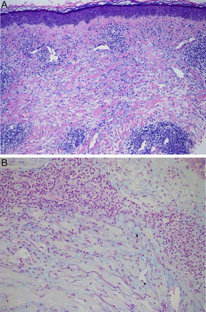HE×40: denso infiltrado inflamatorio linfohistiocítico intersticial (A). Tinción con azul alcián×100: depósito de mucina entre las bandas de colágeno y toda la dermis (B).