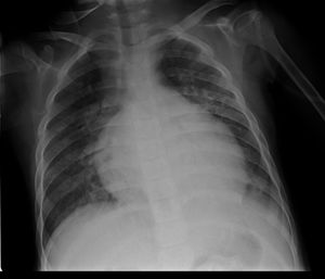 Cardiomegalia y hallazgos de edema pulmonar agudo.