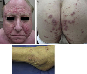 Examen clínico. Pápulas inflamatorias costrosas agrupadas y nódulos distribuidos de forma simétrica a nivel del rostro a), caderas b) y tobillos c).