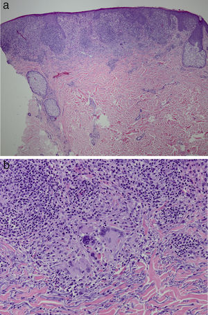 Hallazgos histológicos. Adelgazamiento de la epidermis con una acantosis irregular, discreta espongiosis y paraqueratosis. La dermis papilar está reemplazada casi en su totalidad por granulomas a). Reacción granulomatosa con macrófagos prominentes y células gigantes b). (Hematoxilina y eosina, x10).