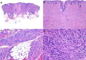 Histología típica de un leiomiosarcoma. a) Visión panorámica de una tumoración dérmica mal delimitada que infiltra al tejido celular subcutáneo. b) A mayor detalle la formación en dermis de fascículos de células fusiformes entrelazadas y distribuidos irregularmente por la dermis y que recuerdan a fibras musculares. c) La tumoración infiltra el tejido celular subcutáneo. d) Fascículos de células fusiformes pleomórficas que se entrecruzan en ángulo recto y la presencia de figuras mitósicas.