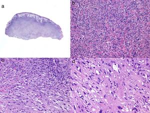 Histología de un sarcoma pleomórfico. a) Panorámica de una lesión tumoral que infiltra la dermis e hipodermis. b) Tumor constituido por células fusiformes siguiendo un patrón estoriforme. c) Las células se encuentran inmersas en un estroma mixoide. d) Detalle de algunas células más pleomórficas con citoplasma amplio.