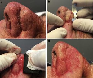 Técnica quirugica de super shaving. (a) Podemos observar el efecto en trampilla como complicación de cierre por colgajo de trasposición con pedículo. (b) Con la mitad de una hoja de afeitar se procede al afeitado o shaving de toda la parte abultada. (c) Con una lija al agua número 150 embebida en suero fisiológico se realiza el nivelado con el tejido circundante. (d) Se muestra el resultado al terminar el procedimiento.