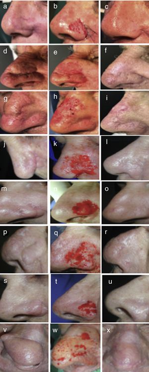 Resultados posquirúrgicos del super shaving. (a,d,g,j,m,p,s,v) Podemos observar el efecto en trampilla previo a la cirguía. (b,e,h,k,n,q,t,w) Se observa el resultado intraoperatorio de la técnica. (c,f,l,o,r,u,x) Control posquirúrgico a los 3 meses. (i) Control posquirúrgico al mes.
