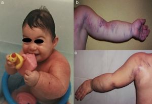 (a) Asimetría de miembros con sobrecrecimiento del miembro superior izquierdo. (b y c) Malformaciones vasculares capilares y venosas en zonas anterior y posterior.