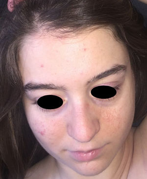Paciente con complejo de esclerosis tuberosa (CET); se evidencian múltiples angiofibromas faciales.