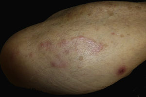 Lesión arciforme en antebrazo derecho. Placa eritematosa de 0,8cm con centro costroso a unos 4cm de la lesión principal.