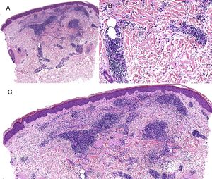 A) Denso infiltrado perivascular superficial y profundo con zonas de necrobiosis en el área central. B) Detalle de linfocitos pequeños perivasculares y linfocitos e histiocitos intersticiales. C) Detalle de necrobiosis central.