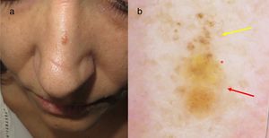 a)Pápula de 4mm en dorso nasal. b)Imagen dermatoscópica con glóbulos marrones en la mitad superior (flecha amarilla), áreas amarillentas sin estructura en la inferior (flecha roja) y vasos lineales regulares (asterisco rojo).