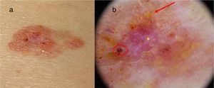a)Placa abdominal eritematoanaranjada bien delimitada de 2,5×1,5cm. b)Imagen dermatoscópica con un fondo eritematoblanquecino (asterisco amarillo), abundantes estructuras globulares amarillentas (flecha roja), erosiones (círculo rojo) y vasos ramificados (asterisco rojo).