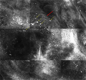 Imagen de microscopía confocal de 1,3×1,25mm. Se observan lóbulos de sebocitos maduros, grandes y brillantes (flecha amarilla) delimitados por una delgada pared de células basalioides (flecha roja).