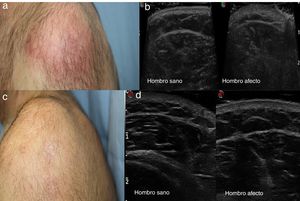 a) Placa eritematosa mal delimitada; b) Estudio ecográfico con engrosamiento de la dermis. Comparación con el hombro no afecto; c) Resolución de la lesión tras el tratamiento, y d) Estudio ecográfico tras el tratamiento, comparando con el hombro no afecto.
