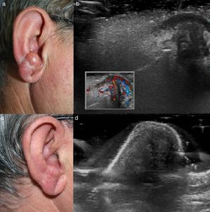 a) Engrosamiento y eritema de antitrago y de lóbulo auricular; b) Estudio ecográfico en el que se observa en la dermis superficial una imagen hipoecoica mal delimitada, más lineal en superficie y peor definida en profundidad, no encapsulada, con aumento del flujo con Doppler, y con características de baja resistencia; c) Resolución de lesión tras el tratamiento, y d) Estudio ecográfico tras el tratamiento.