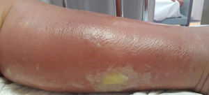 Placa eritematosa brillante de bordes irregulares con vesículas y ampollas en su superficie, localizada en la pierna.