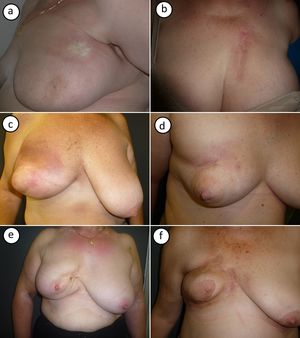 Imagen clínica de los casos de morfea postradioterapia. a) Caso número 1: morfea localizada en parte superior de la mama, cerca de la axila. Placa redondeada indurada, de superficie lisa y color marfil con borde violáceo. b) Caso número 2: morfea localizada en parte superior de la mama. Placa muy indurada sobre zona de radiodermitis. c y d) Los casos números 3 y 4 muestran una morfea en fase inflamatoria que afecta toda la mama. Inflamación con eritema e induración generalizada de la mama, respetando la zona del pezón. e y f) Los casos 5 y 6 muestran una morfea en una fase más residual. Importante retracción mamaria e hiperpigmentación postinflamatoria.