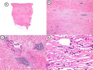Hallazgos histológicos de la biopsia del caso número 4. a) Imagen panorámica con una dermis muy engrosada y poco tejido celular subcutáneo (HE, x4). b) Detalle del engrosamiento de los haces de colágeno (HE, x40). c) Detalle del infiltrado inflamatorio perianexial (HE, x40). d) Células plasmáticas y linfocitos como componentes fundamentales del infiltrado inflamatorio (HE, x40).