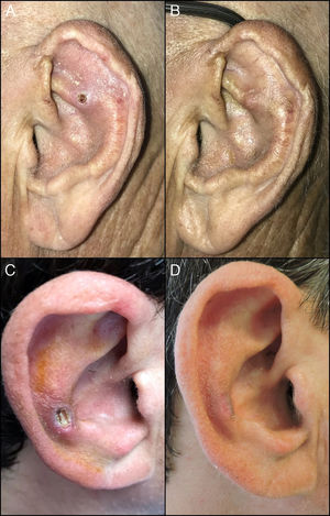 A: caso 1 previo inicio del tratamiento; B: caso 1 tras finalizar tratamiento con diltiazem tópico al 2%; C: caso 2 previo inicio del tratamiento; D: caso 2 tras finalizar el tratamiento con diltiazem tópico al 2%.