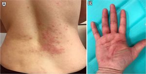 Imágenes clínicas. A) Lesiones eritematosas inespecíficas en tronco. B) Lesiones afectando principalmente los pliegues de la mano.