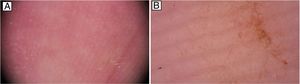 Imágenes dermatoscópicas. A) A menor aumento se aprecian los dermatoglifos de la palma de la mano con estructuras lineales superimpuestas que se corresponden con los pelos de la oruga procesionaria. B) Detalle de los pelos urticantes.
