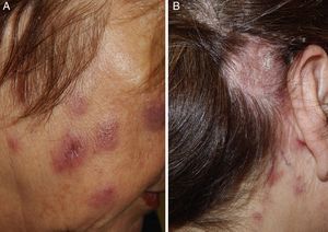 A) Placas eritemato-violáceas de aspecto suculento sin cambios en la superficie, localizadas a nivel facial. B) Placa eritemato-marronácea, descamativa, alopécica a nivel del cuero cabelludo retroauricular.