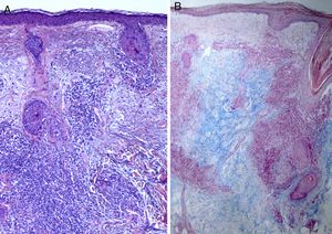 Biopsia de piel facial en la que se observa discreta atrofia epidérmica con moderado infiltrado linfocitario perivascular y perianexial y abundante depósito dérmico de mucina. A) Hematoxilina-eosina ×10. B) Azul alcián ×4.