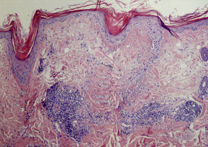 Biopsia de cuero cabelludo donde se observa dermatitis linfocitaria perivascular y perianexial con atrofia epidérmica con paraqueratosis y formación de tapones córneos en ostiums foliculares (hematoxilina-eosina ×20).