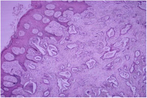 Piel con metástasis de adenocarcinoma×40. Hematoxilina-eosina×40. Piel con metástasis de adenocarcinoma. Hay infiltración dérmica por proliferación epitelial maligna distribuida en patrón glandular irregular, con pleomorfismo celular.