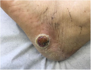 Tumor pétreo en el pie. Tumor pétreo con superficie mamelonada en cara lateral del pie izquierdo. Histopatología concordante con adenocarcima tubular moderadamente diferenciado. En conjunto con los datos extraídos de la ficha clínica concluye que se trata de un adenocarcinoma de vesícula biliar.