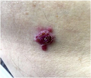 Tumor eritematoso en el brazo. Tumor eritematoso con superficie ulcerada en la piel del brazo derecho. Biopsia compatible con metástasis cutánea de carcinoma de células claras renal. SOX 8 (+). SOX 8 (+): SRY (región determinante del sexo Y)-box 8.